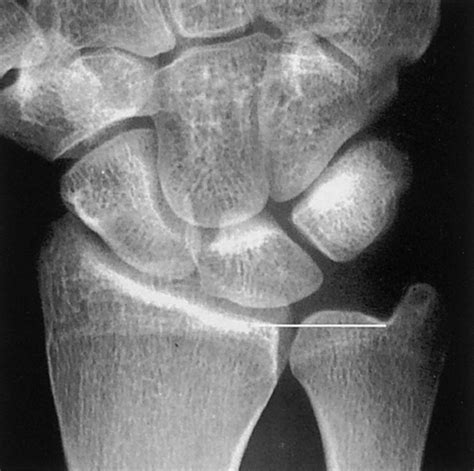 ulnar styloid impaction test|positive ulnar variance causes.